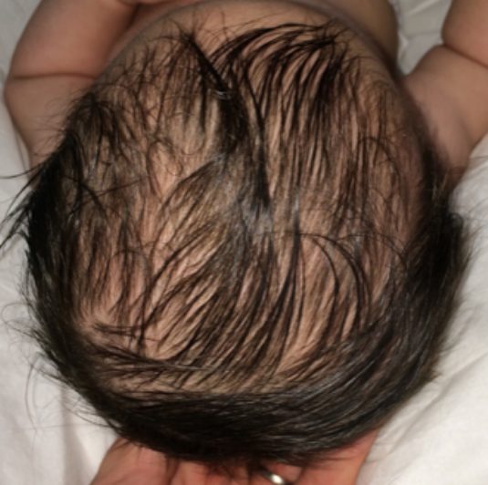 Crâne du bébé vu de dessus, après l'accompagnement