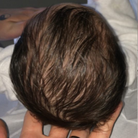 Crâne du bébé vu de dessus, avant l'accompagnement